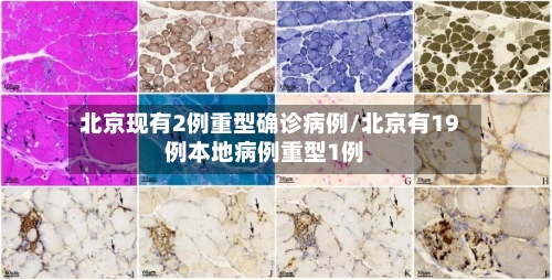 北京现有2例重型确诊病例/北京有19例本地病例重型1例